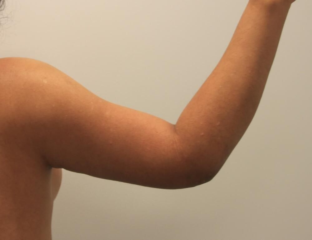 Arm Liposuction Before & After