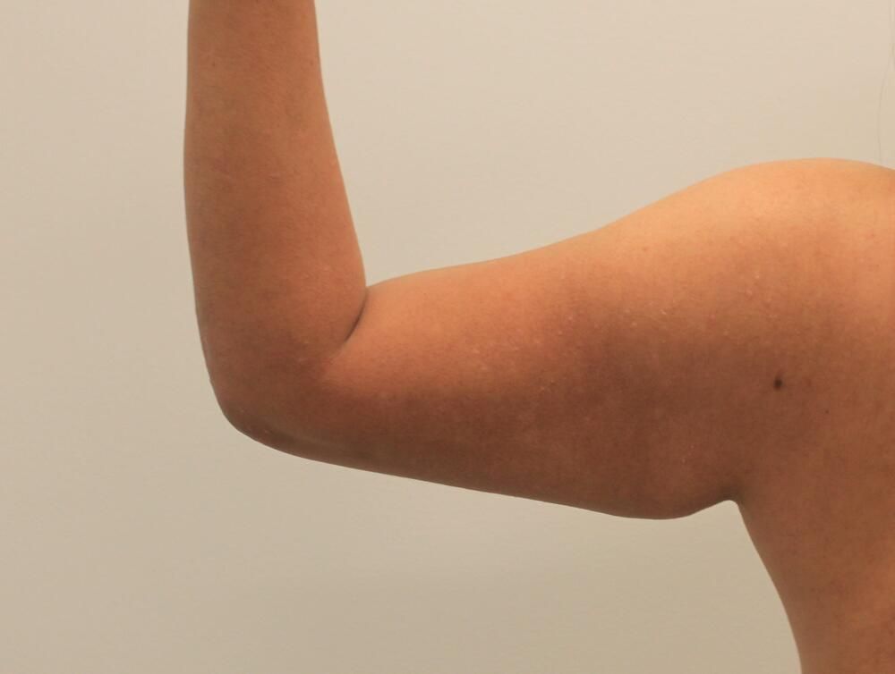 Arm Liposuction Before & After