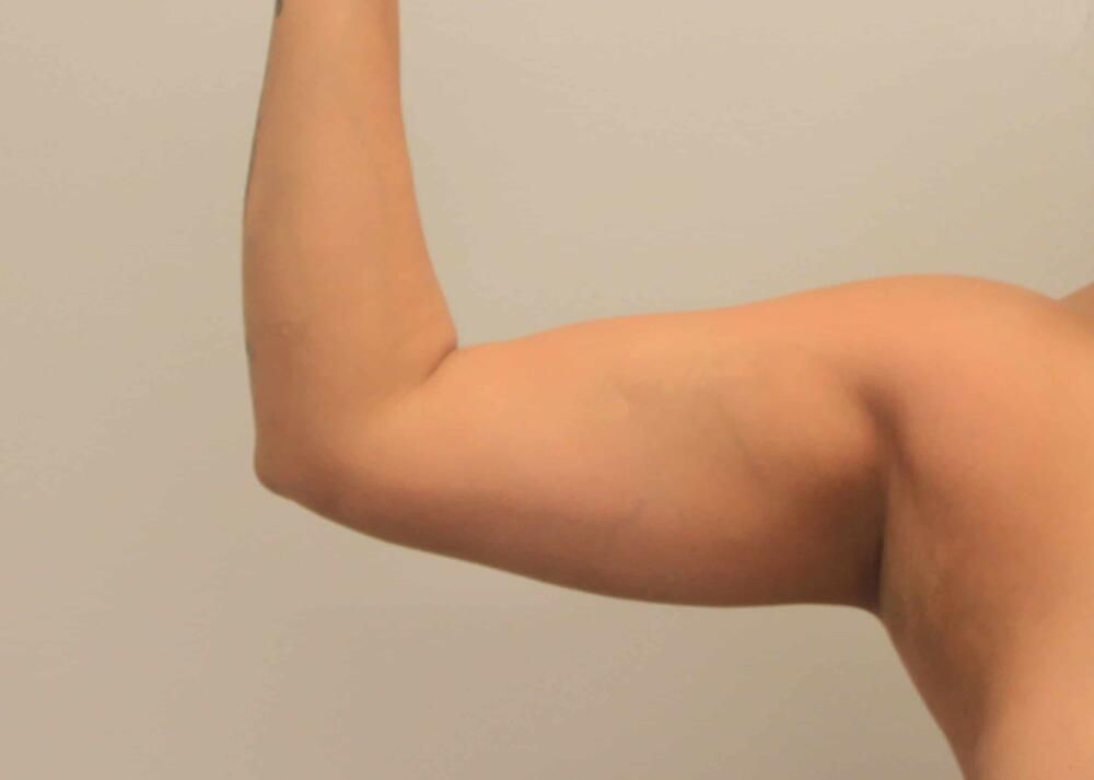 Arm Liposuction Before & After