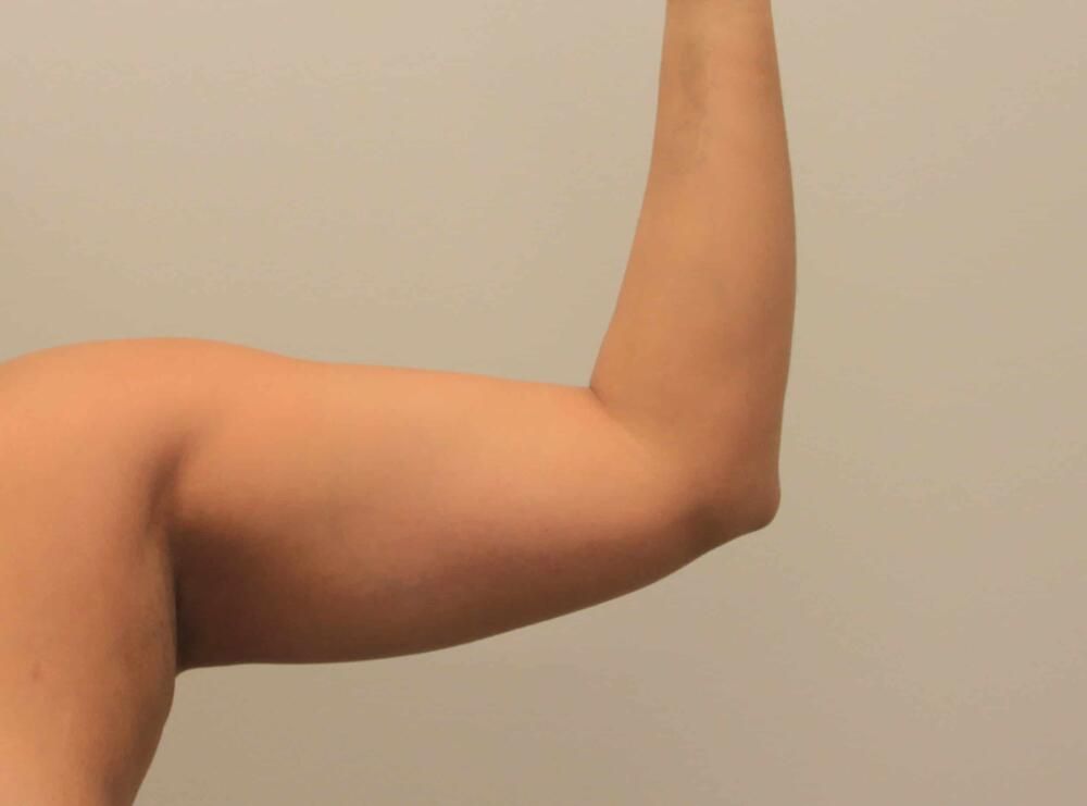 Arm Liposuction Before & After