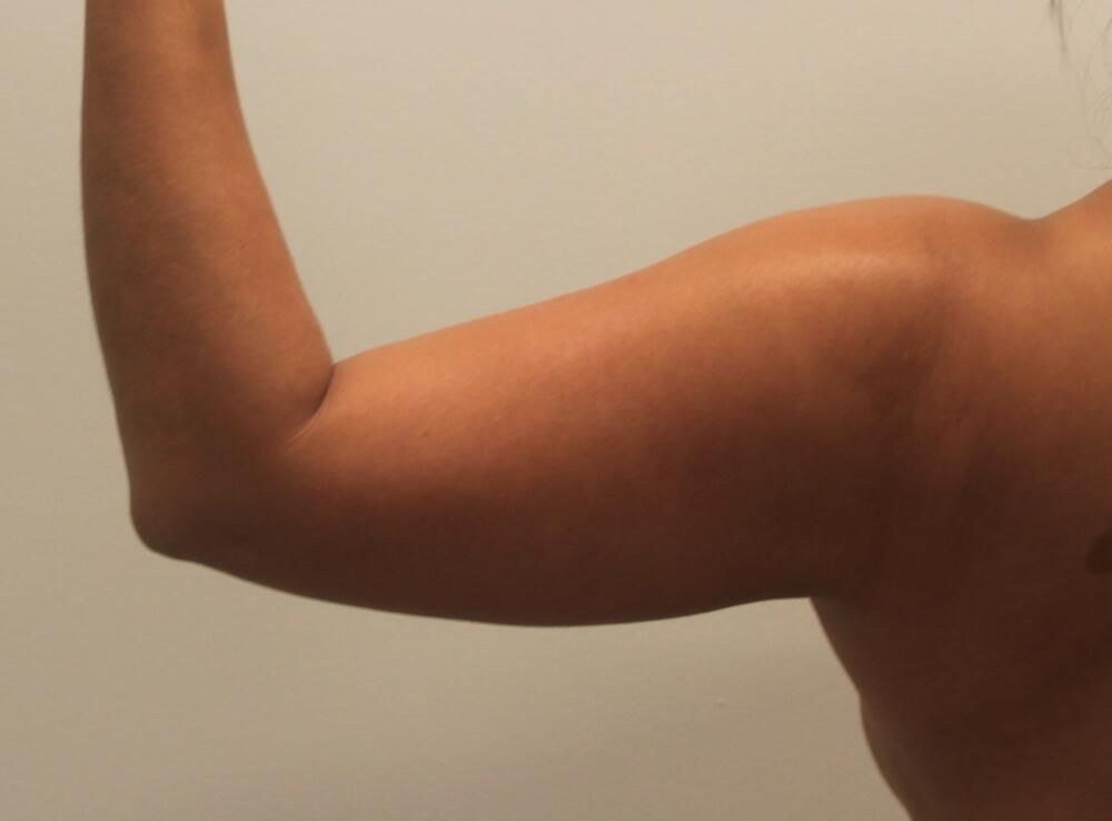 Arm Liposuction Before & After