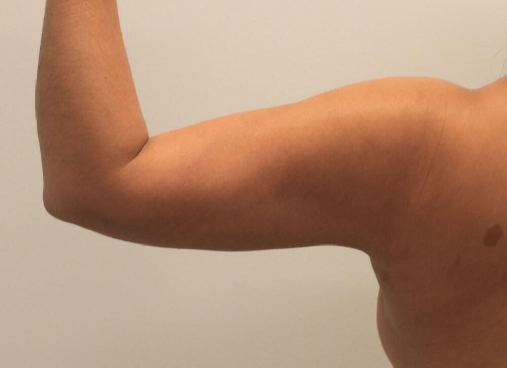 Arm Liposuction Before & After