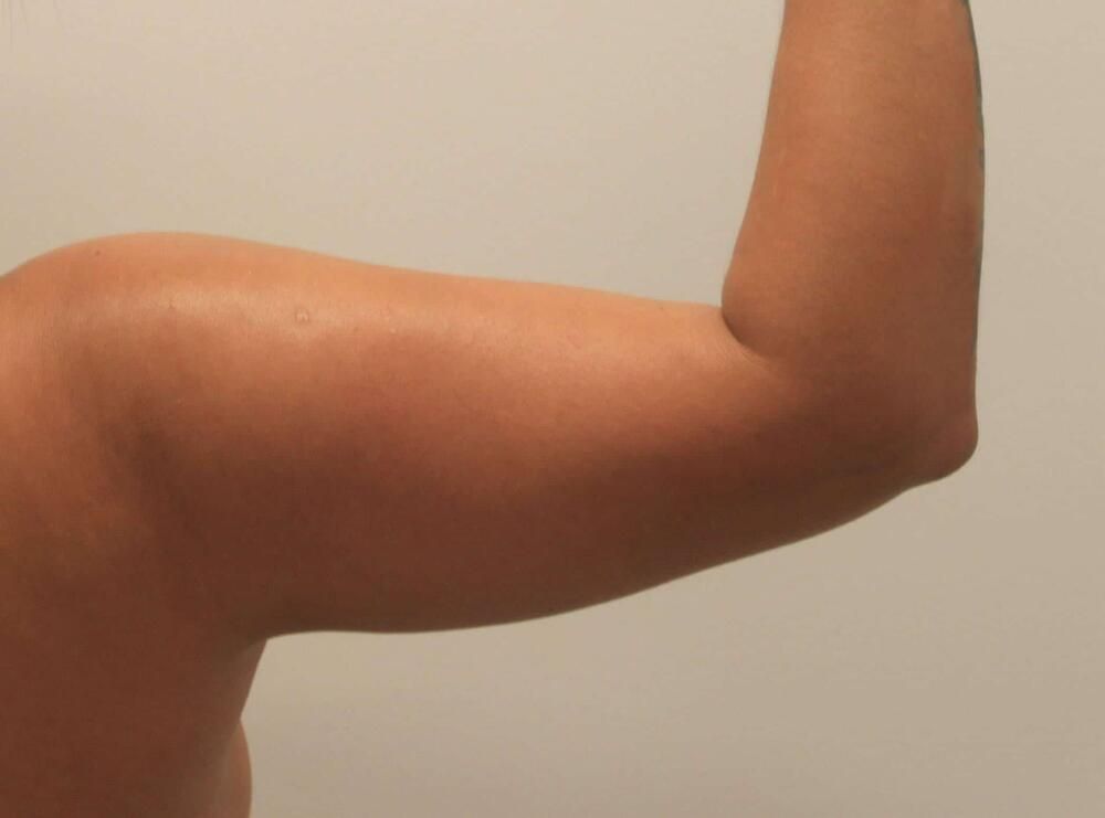 Arm Liposuction Before & After