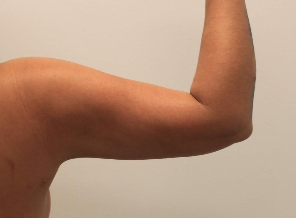 Arm Liposuction Before & After