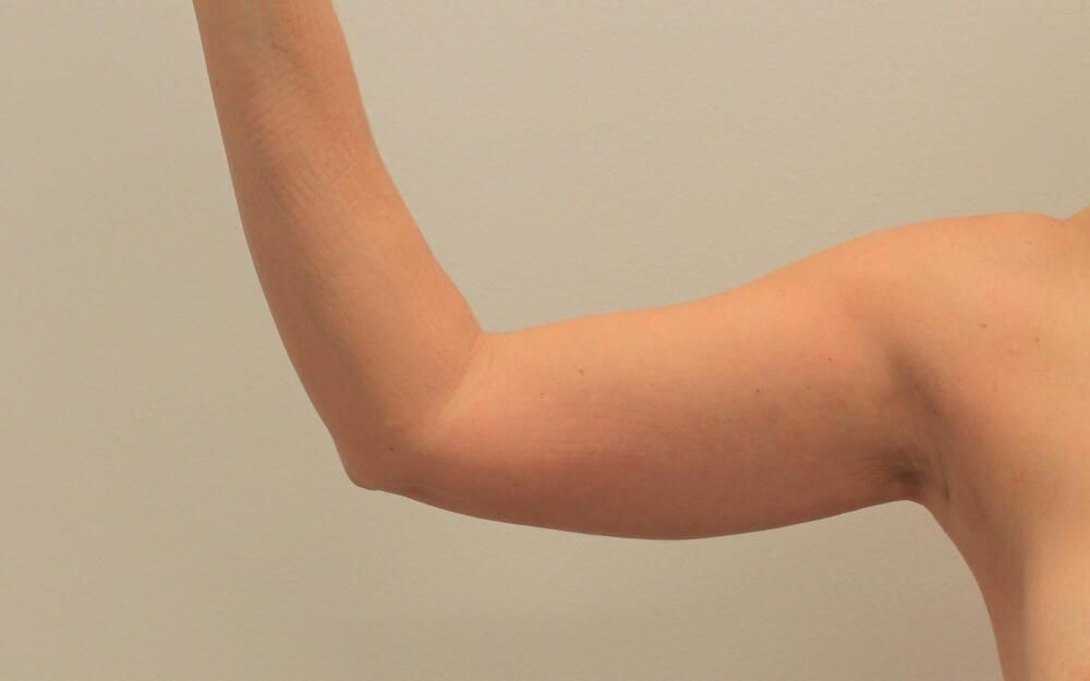 Arm Liposuction Before & After