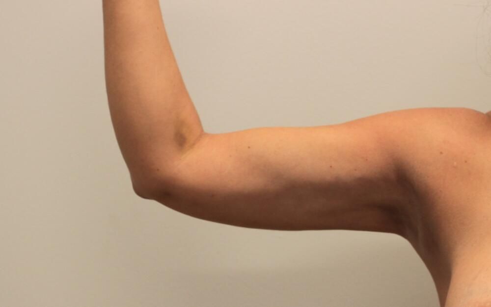Arm Liposuction Before & After