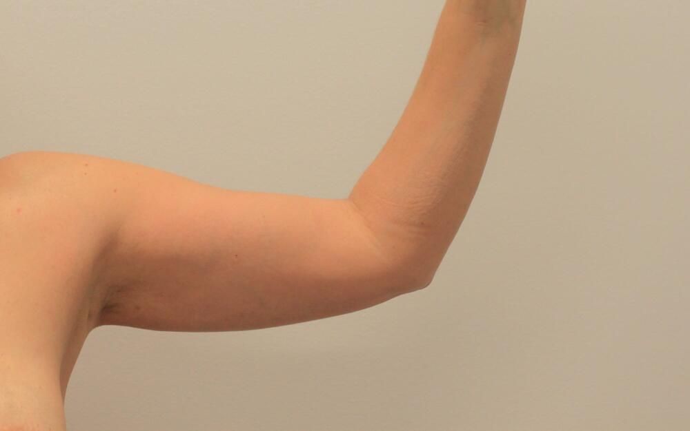 Arm Liposuction Before & After