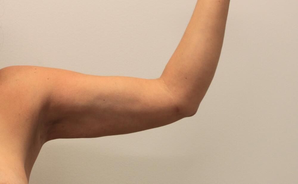 Arm Liposuction Before & After