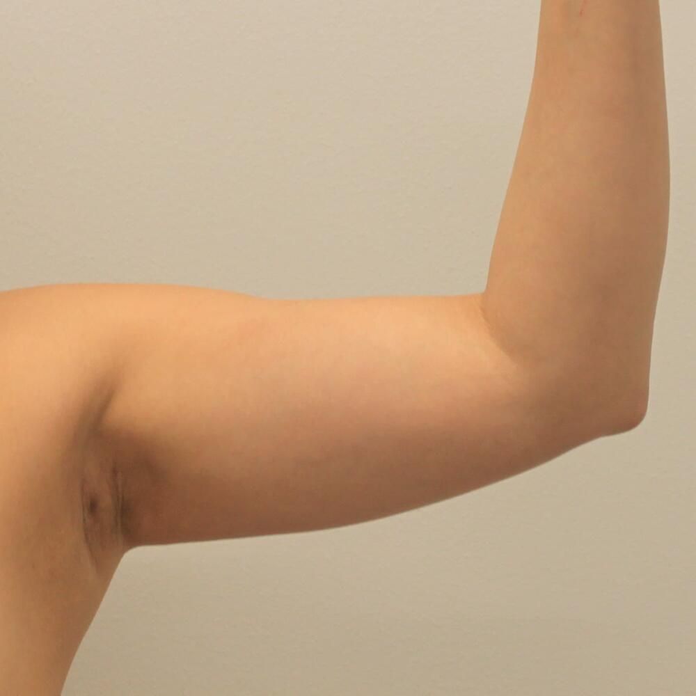 Arm Liposuction Before & After