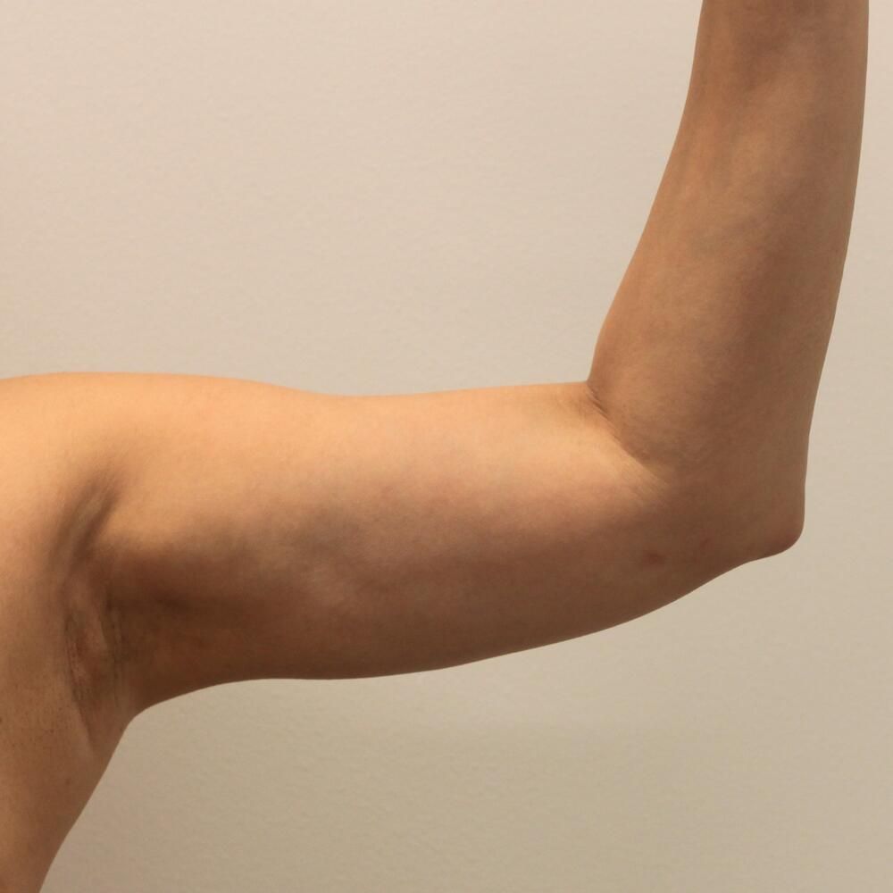 Arm Liposuction Before & After