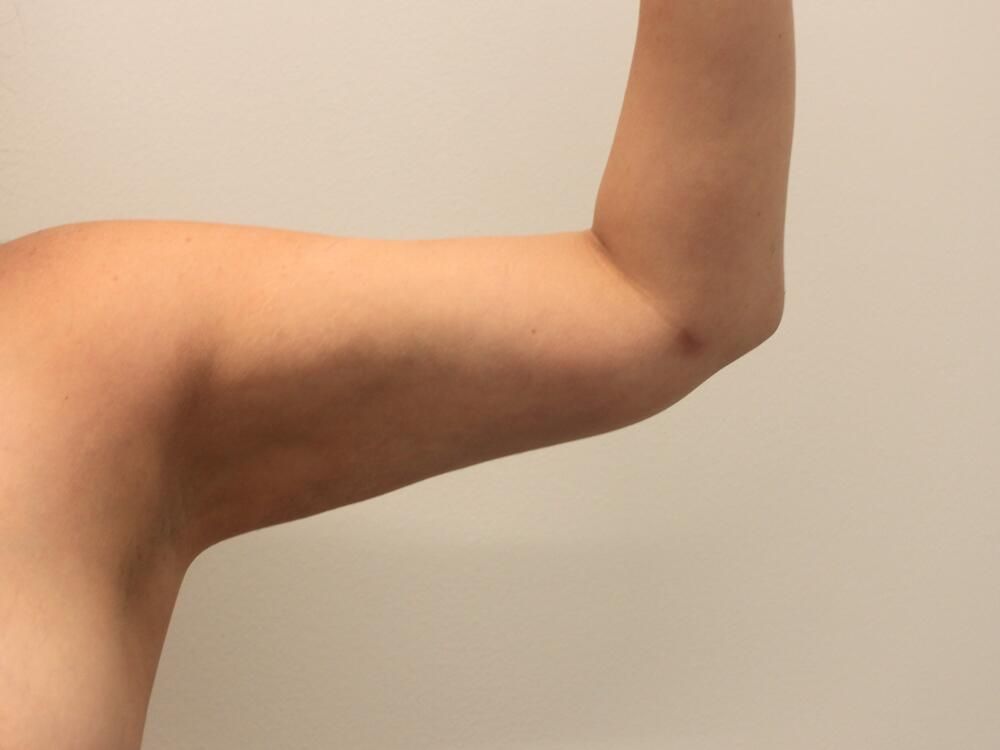 Arm Liposuction Before & After