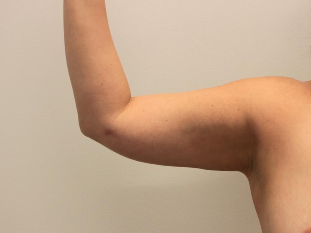 Arm Liposuction Before & After