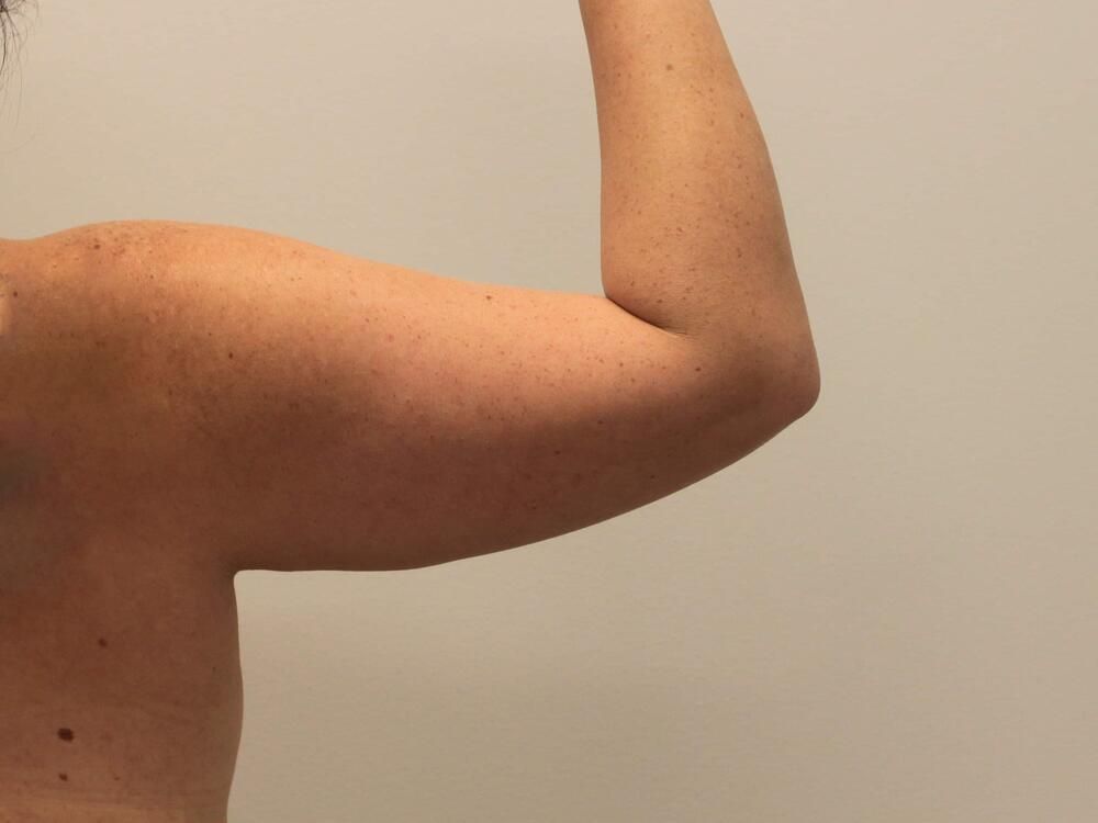 Arm Liposuction Before & After