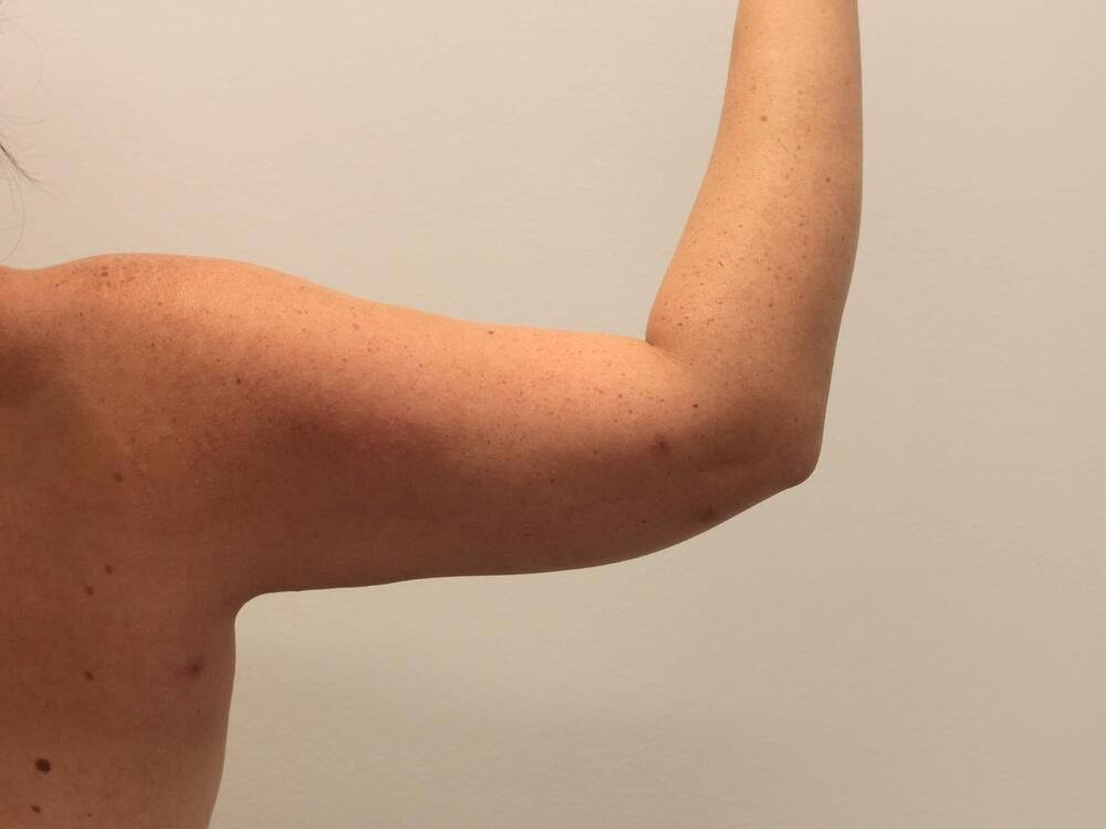 Arm Liposuction Before & After