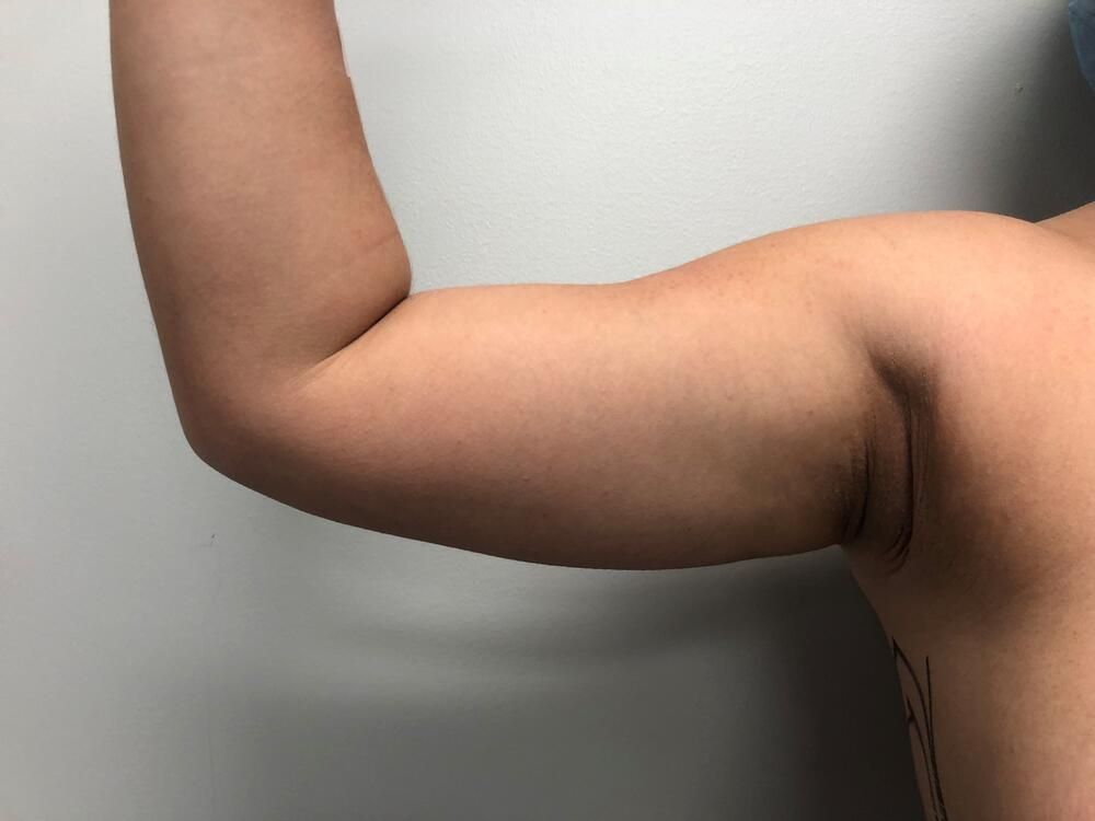 Arm Liposuction Before & After