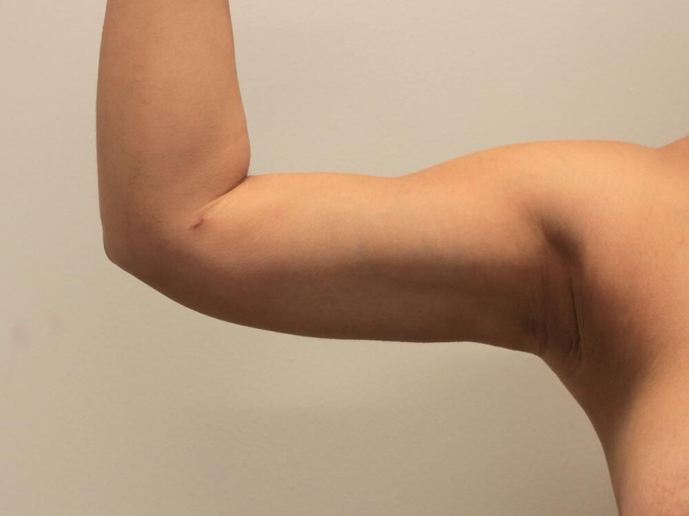 Arm Liposuction Before & After