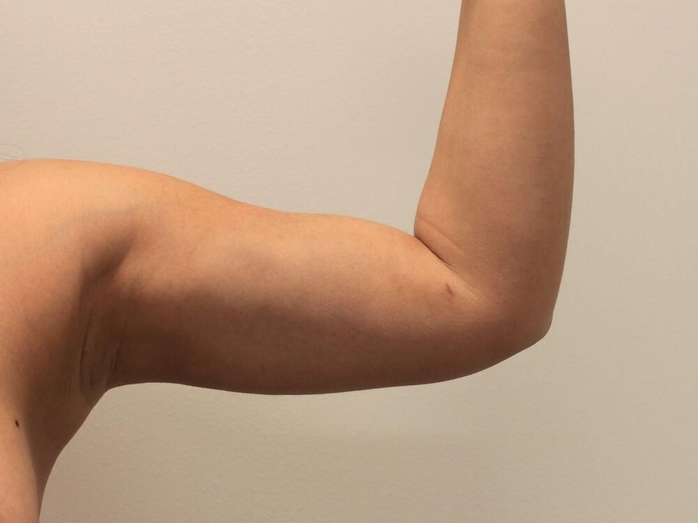 Arm Liposuction Before & After