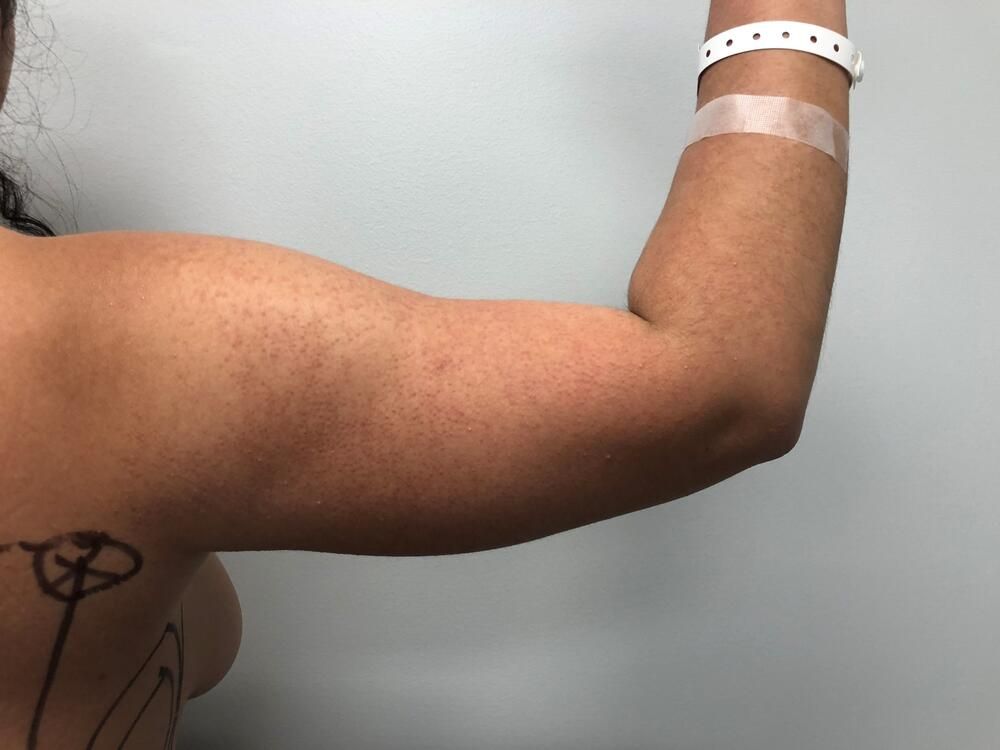 Arm Liposuction Before & After