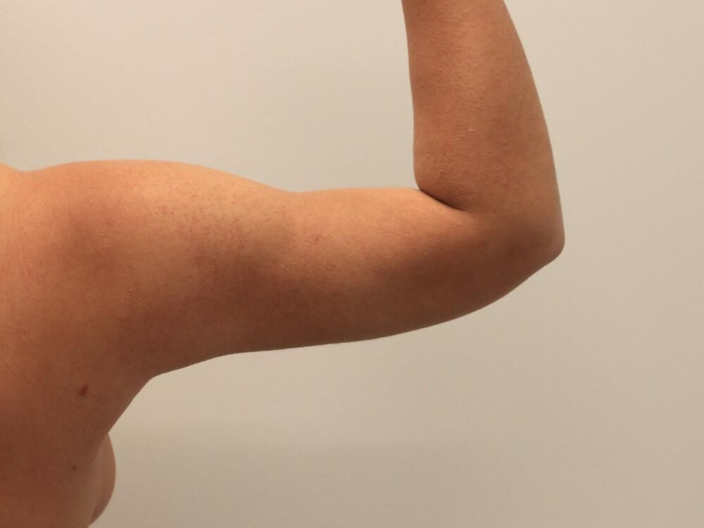 Arm Liposuction Before & After