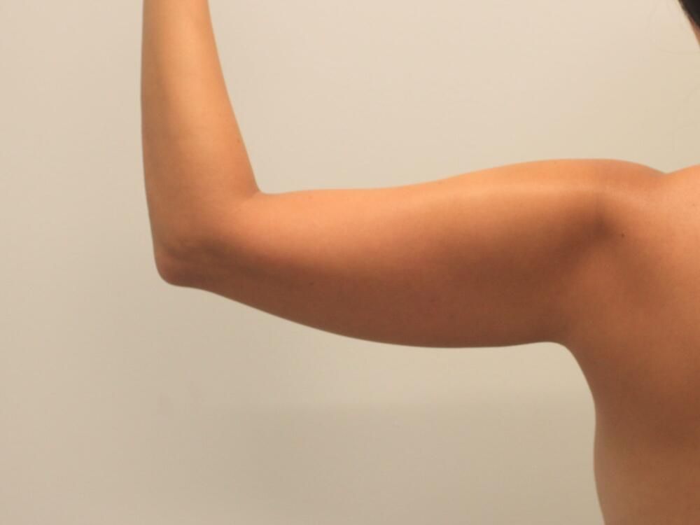 Arm Liposuction Before & After