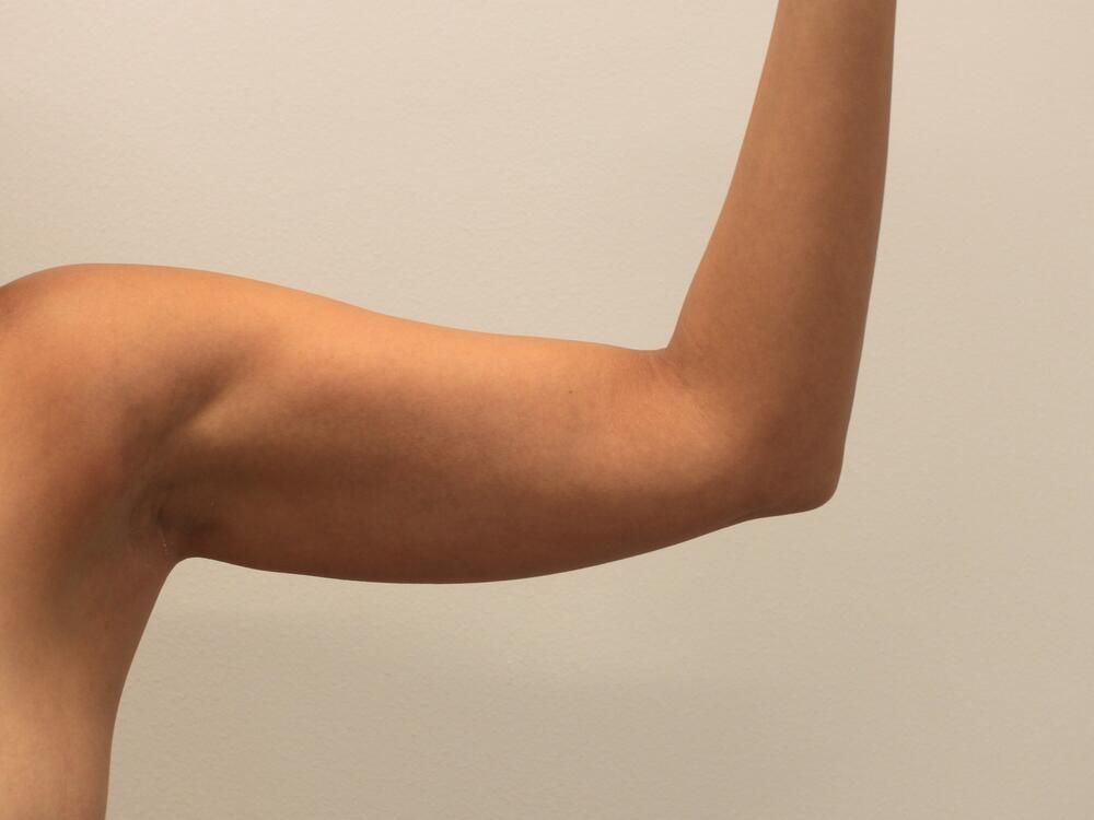 Arm Liposuction Before & After