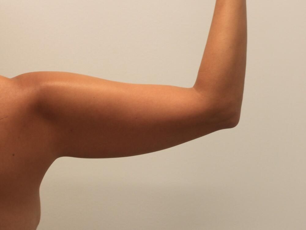 Arm Liposuction Before & After