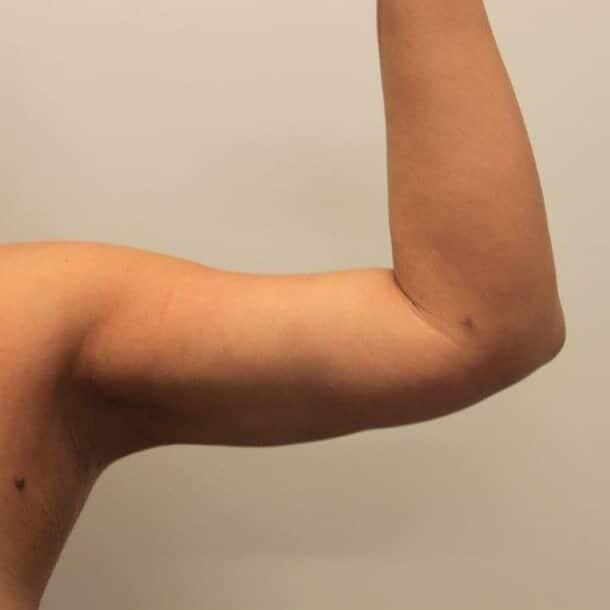 Arm Liposuction Before & After