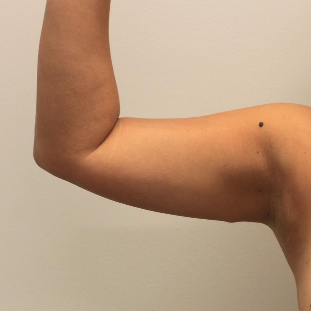 Arm Liposuction Before & After