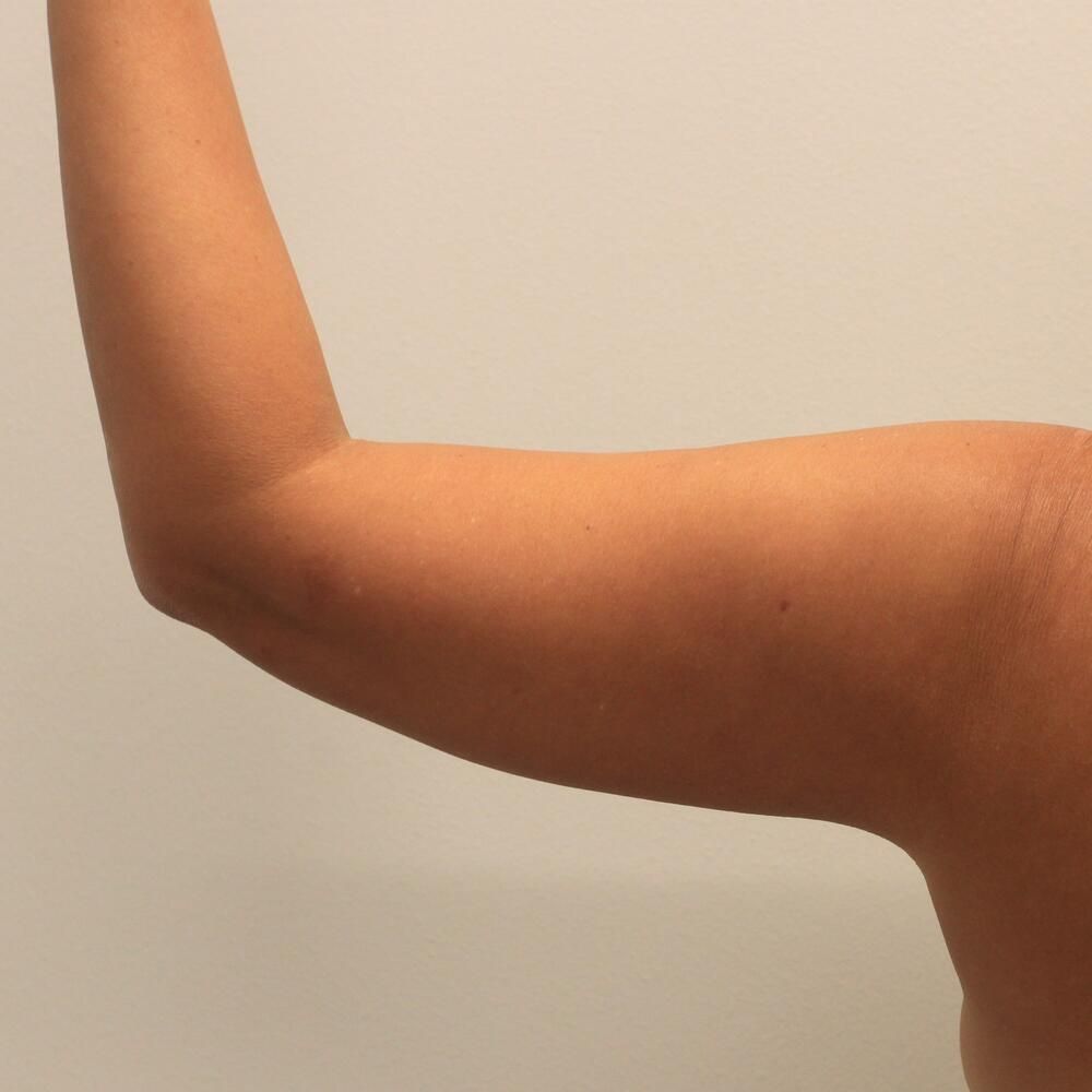 Arm Liposuction Before & After