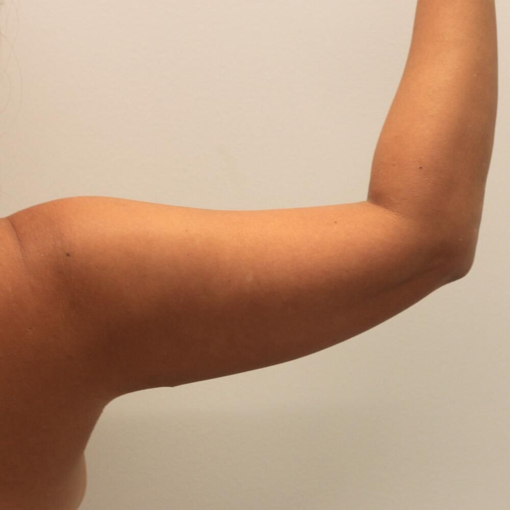 Arm Liposuction Before & After