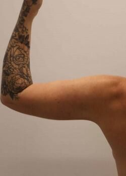 Arm Liposuction Before & After