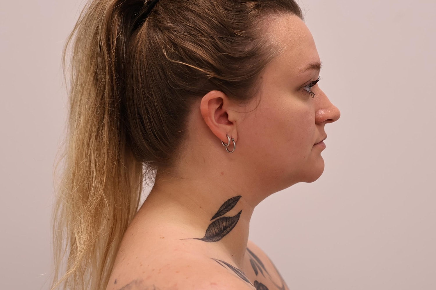 Neck Liposuction Before & After