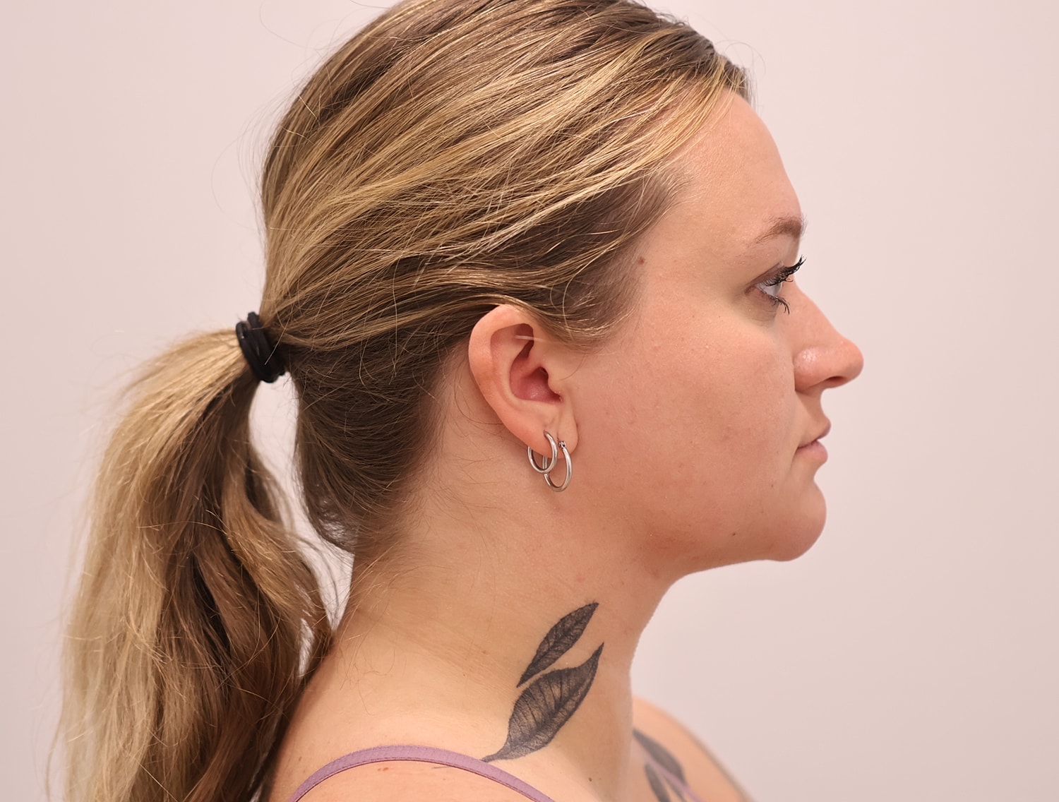 Neck Liposuction Before & After