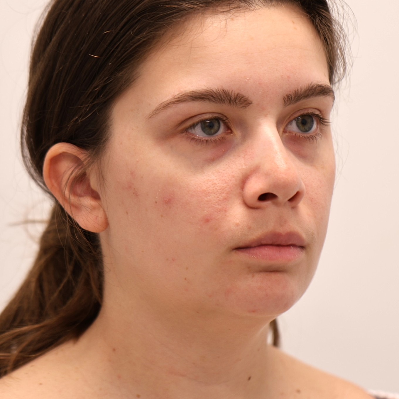 Neck Liposuction Before & After