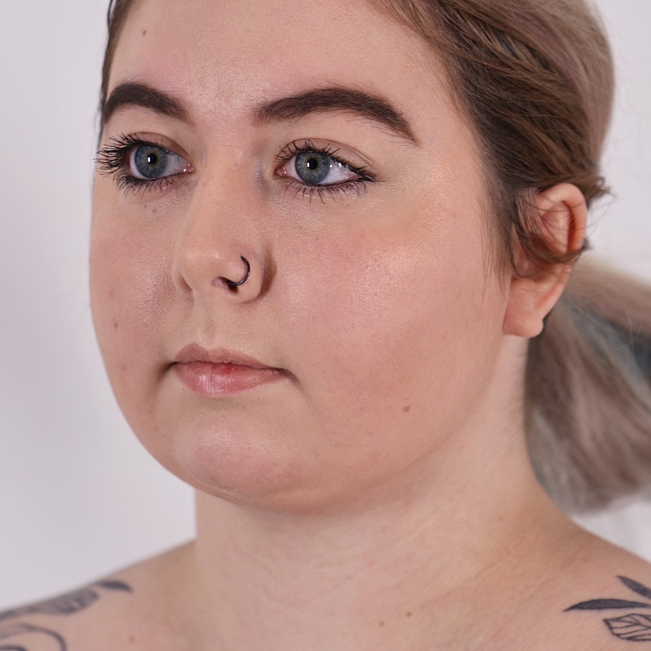 Neck Liposuction Before & After