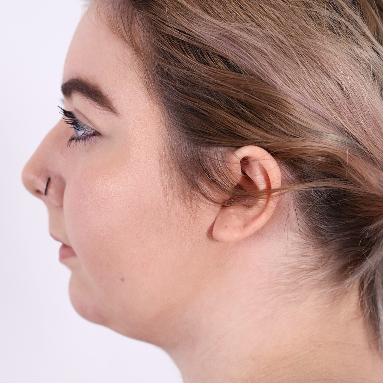 Neck Liposuction Before & After