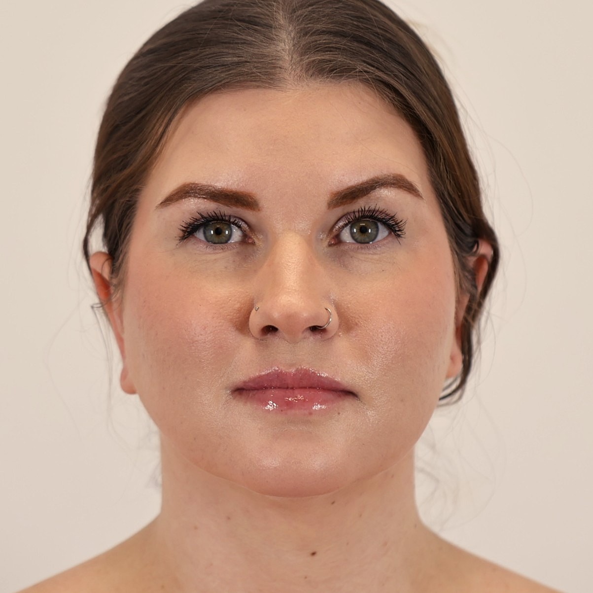 Neck Liposuction Before & After