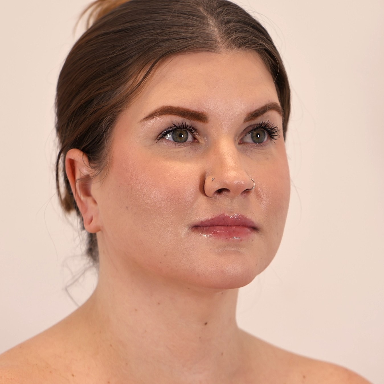 Neck Liposuction Before & After