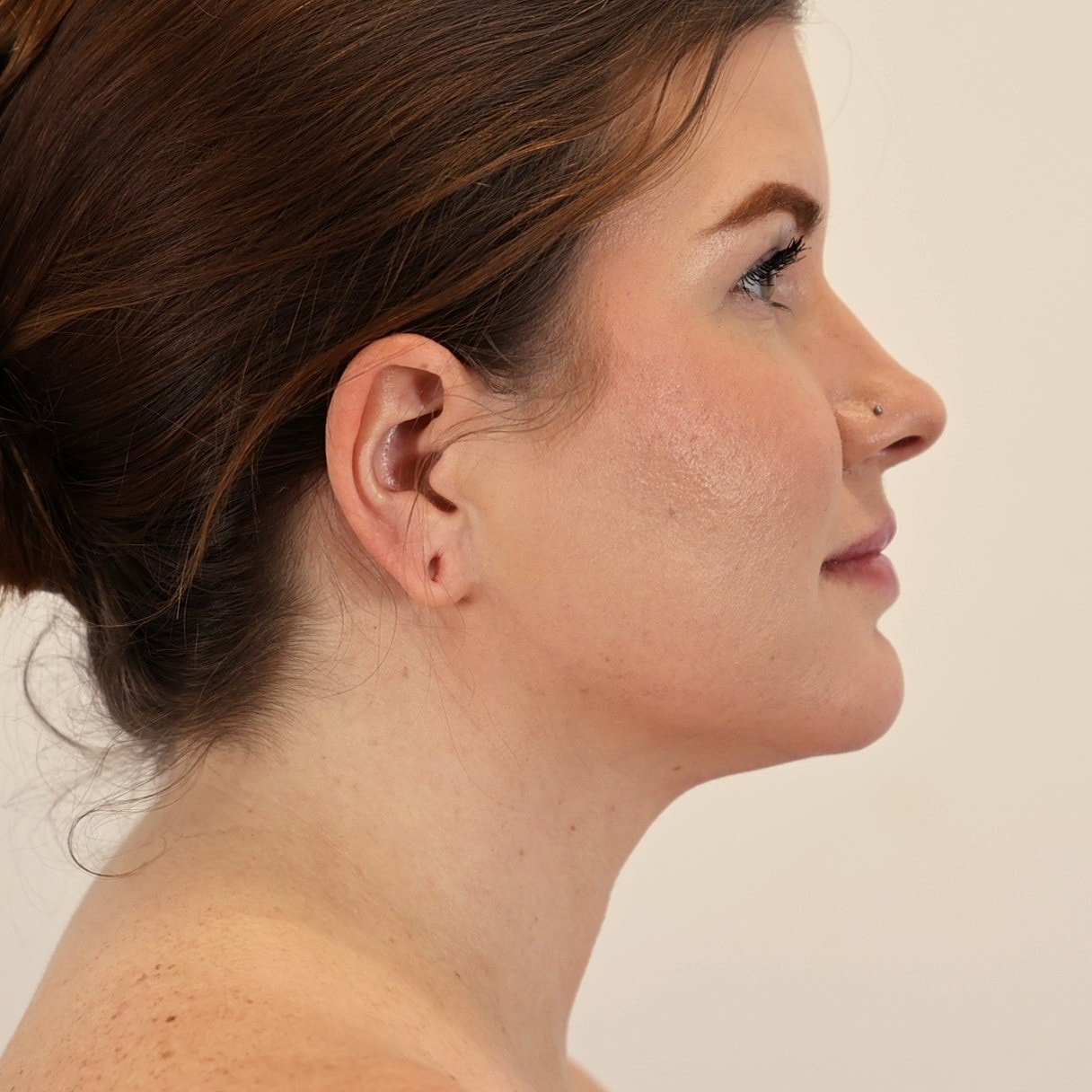 Neck Liposuction Before & After