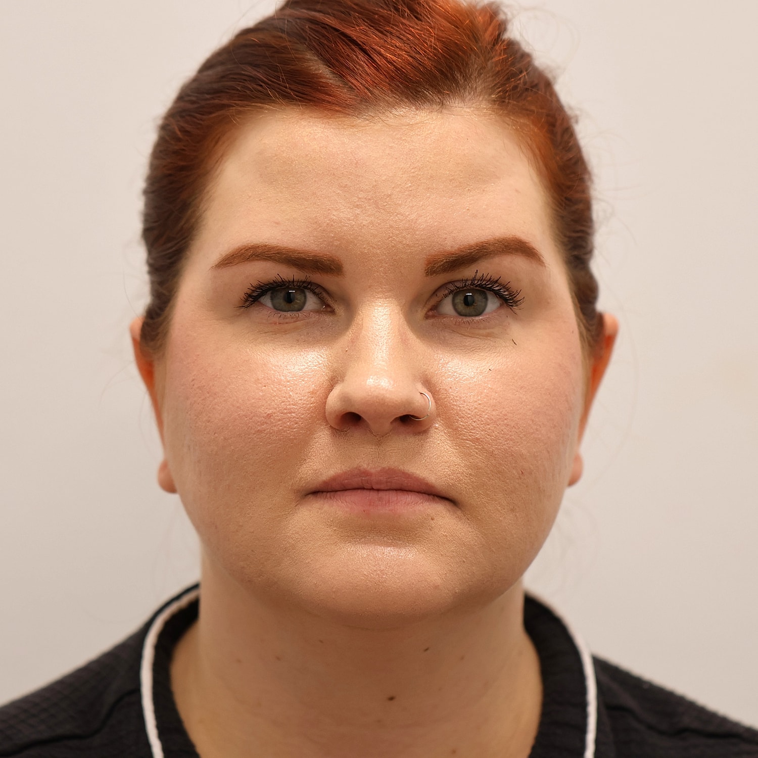 Neck Liposuction Before & After