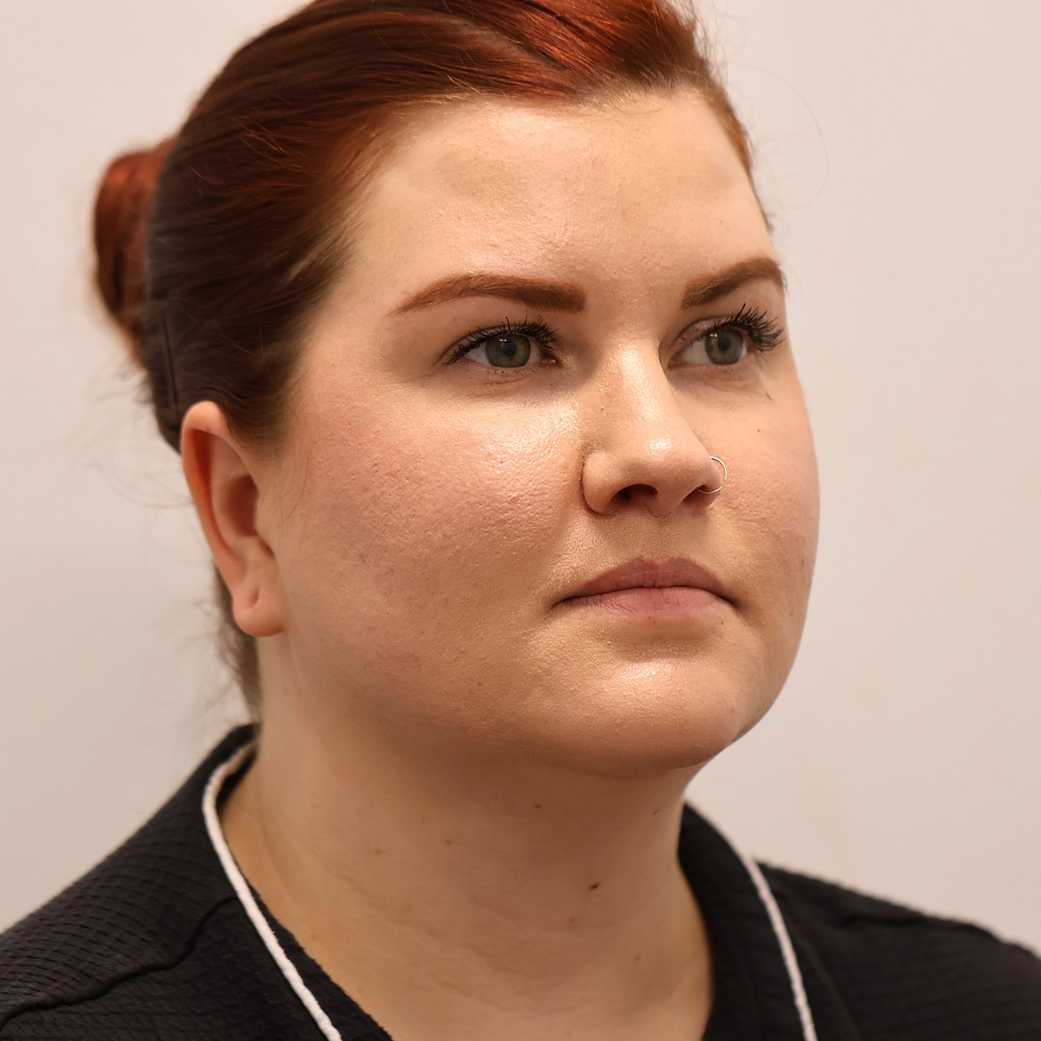 Neck Liposuction Before & After