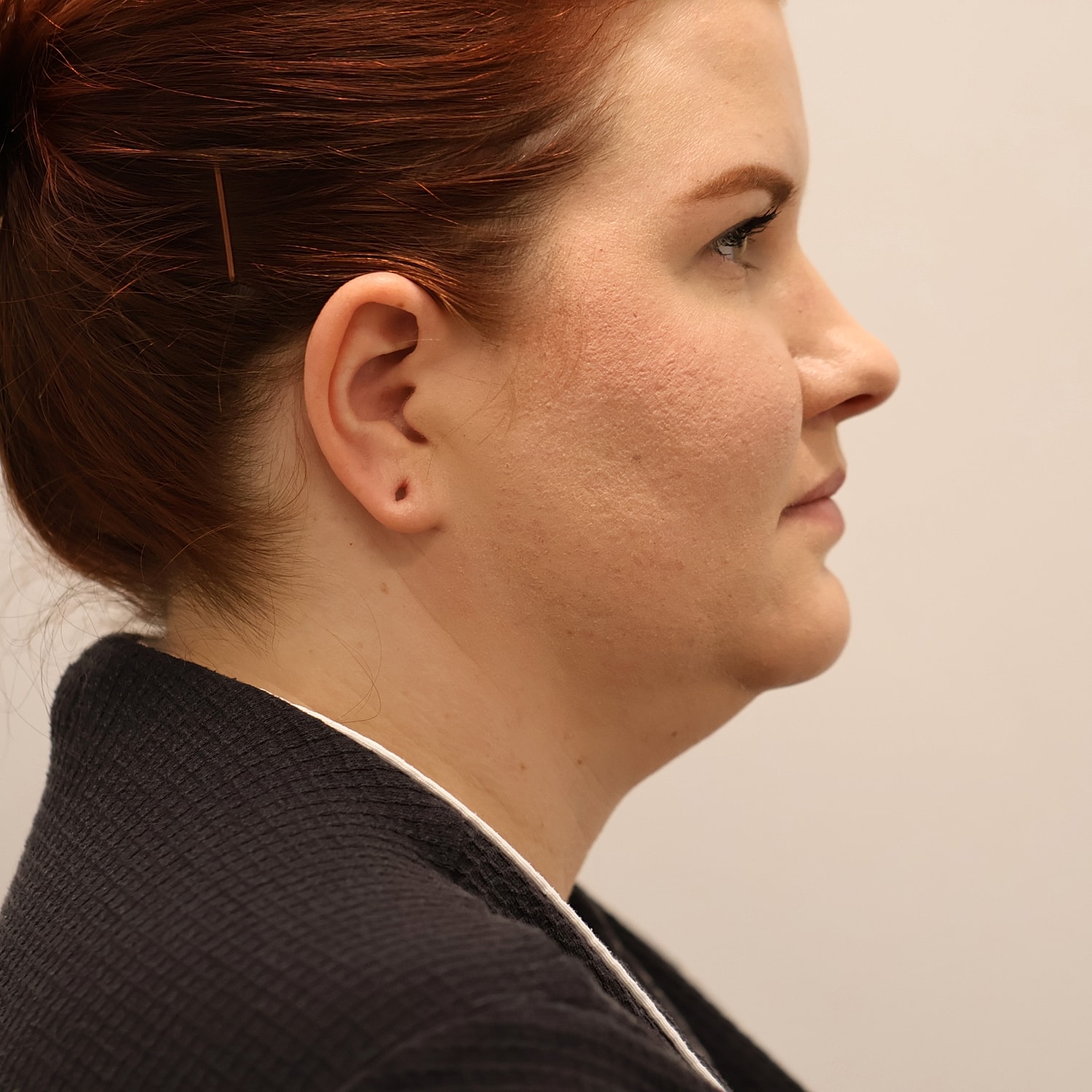 Neck Liposuction Before & After