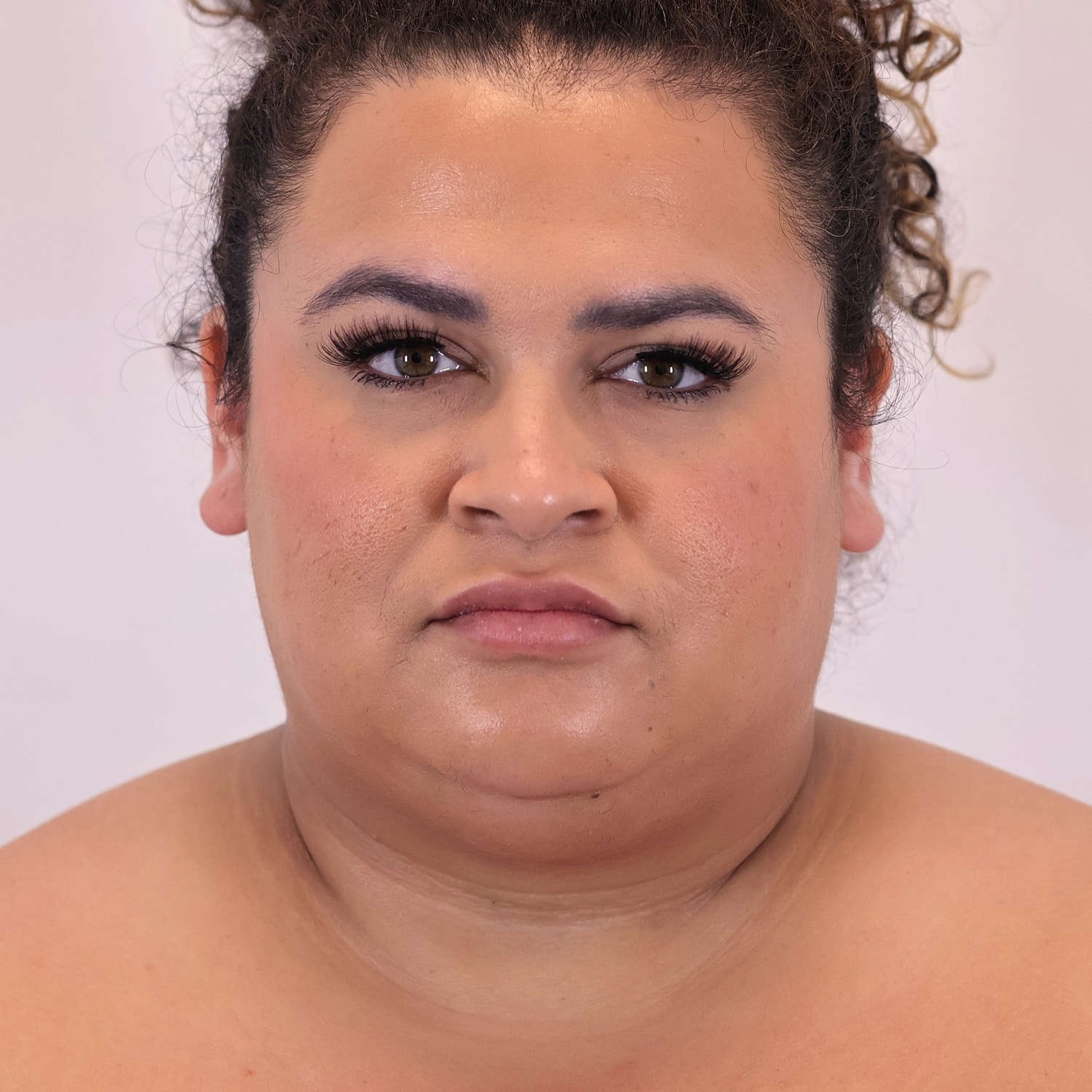 Neck Liposuction Before & After