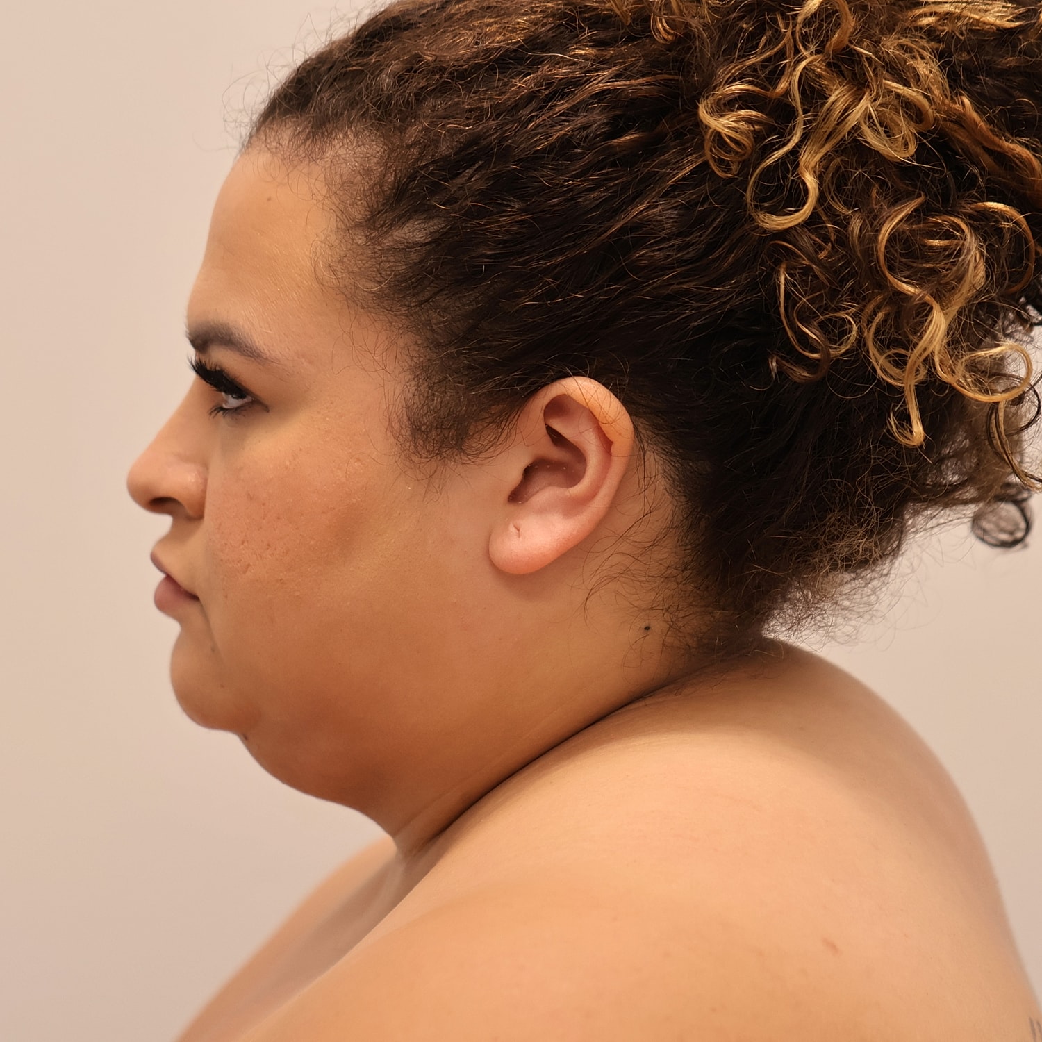 Neck Liposuction Before & After