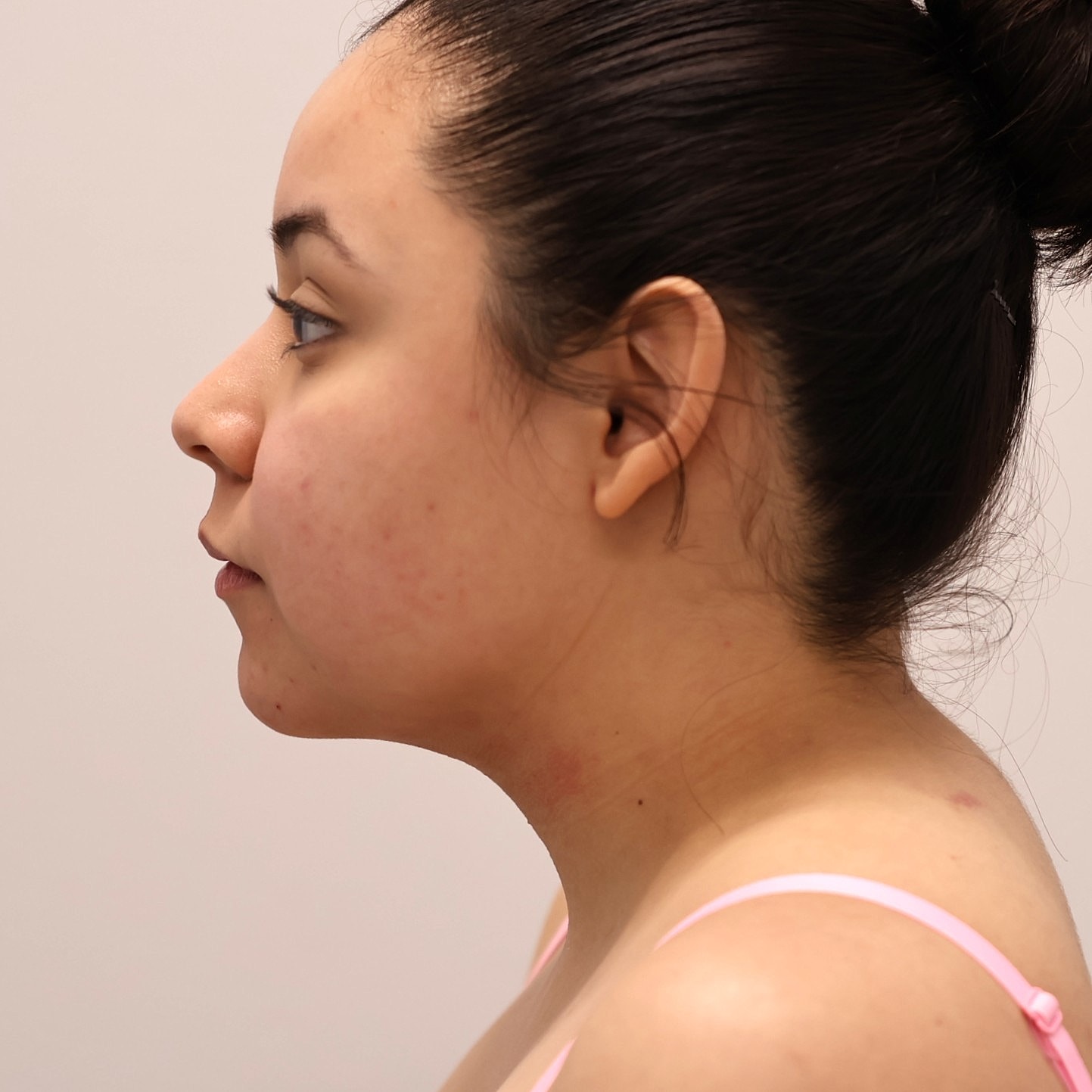 Neck Liposuction Before & After