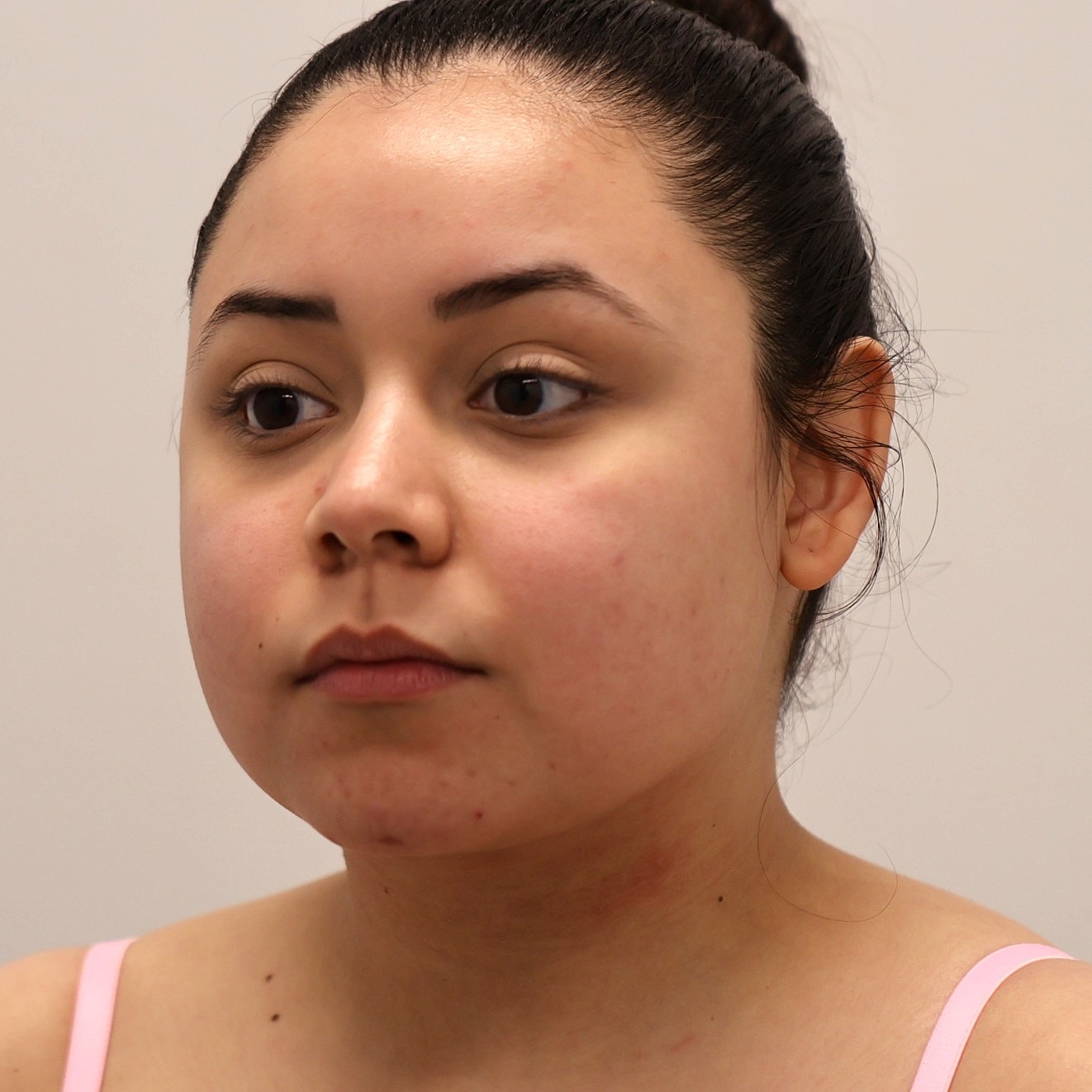 Neck Liposuction Before & After