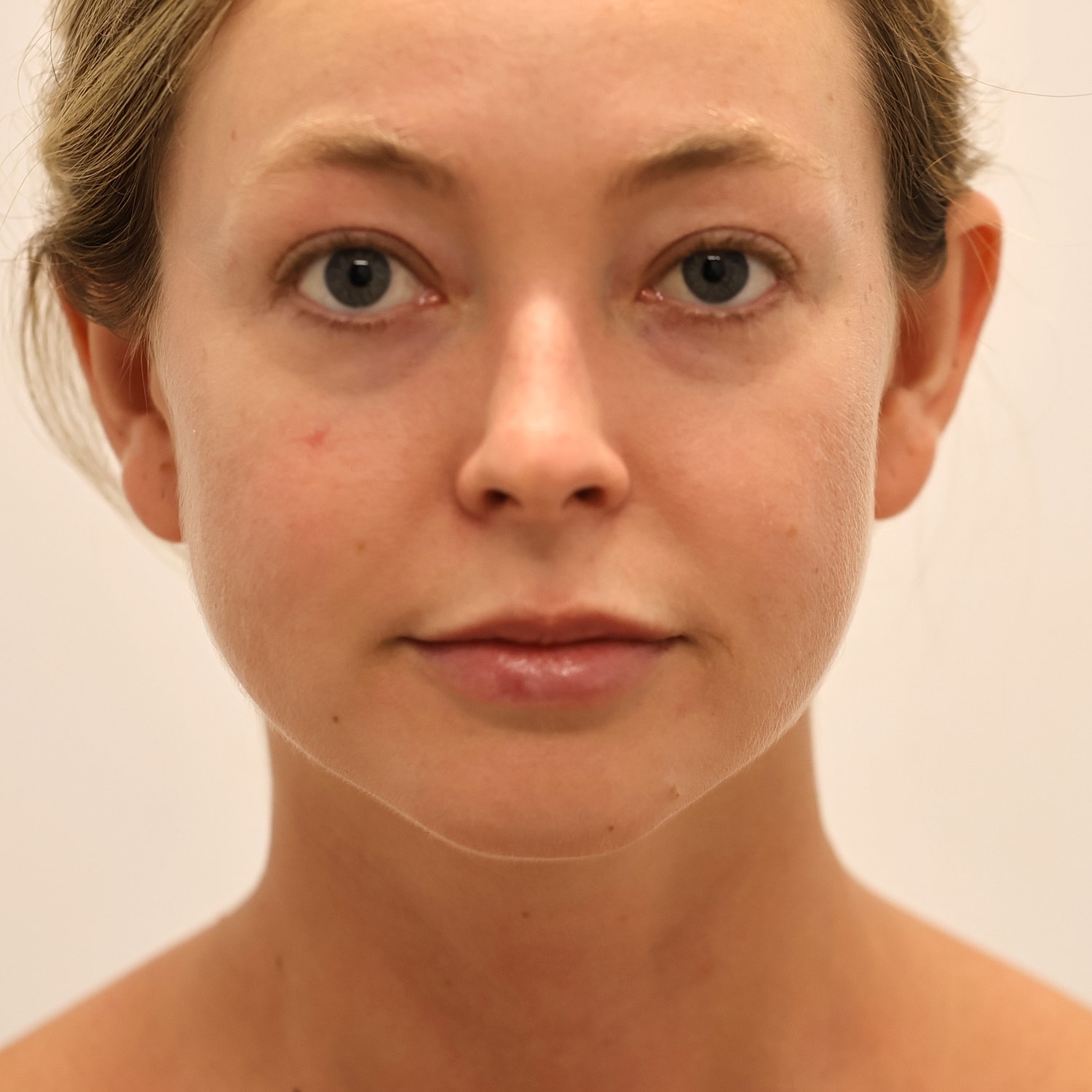 Neck Liposuction Before & After