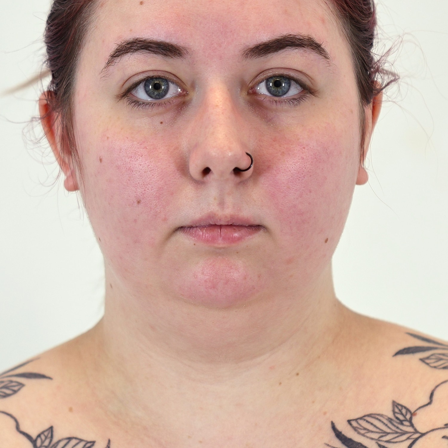 Neck Liposuction Before & After