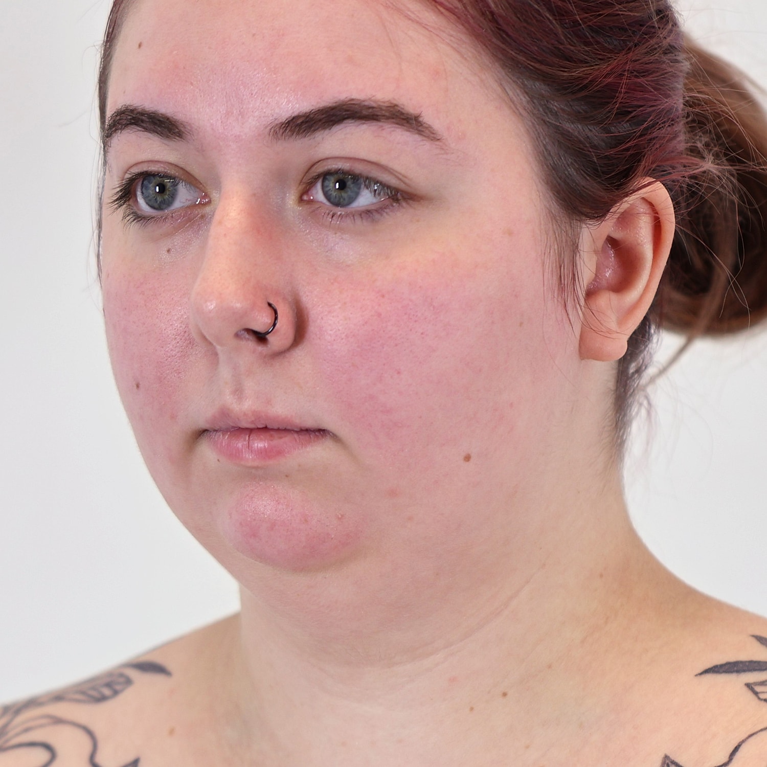 Neck Liposuction Before & After