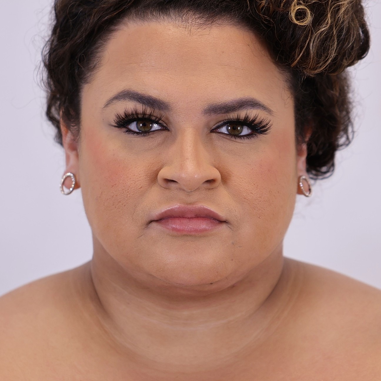 Neck Liposuction Before & After